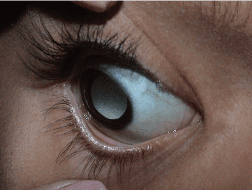 Eye problems caused by a roundworm larva that has gotten stuck in the eye.