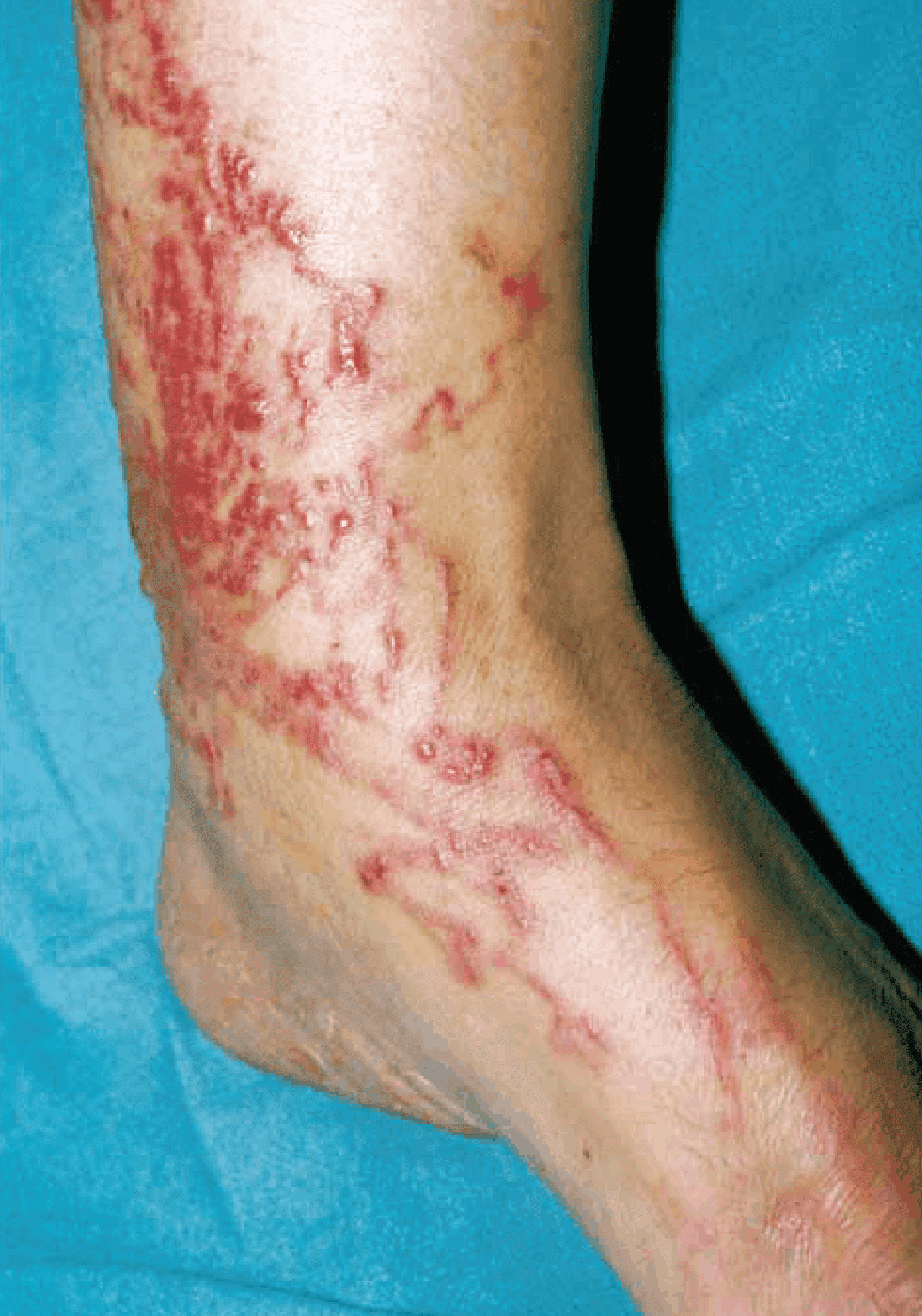 A very bad case of cutaneous larval migrans. Cases that are this bad are mostly seen in non-Indigenous people working in communities. Photo courtesy: Bart Currie, Menzies School of Health Research