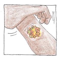 Skin sore illustration